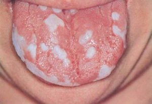 Candidiasis bucal - lengua blanca