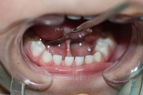 cirugia como tratamiento al frenillo lingual corto