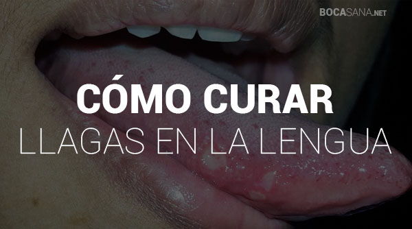 cómo curar las llagas en la lengua