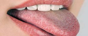lengua blanca por problema inmunologico