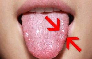 causas de las llagas de lengua