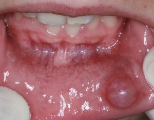 nodulo en boca-lengua