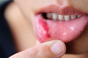 sangrado de boca y/o lengua - cancer de lengua
