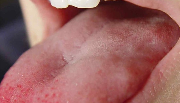 sintomas del cancer de lengua