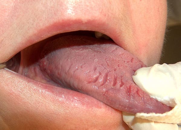 sintomas lengua agrietada