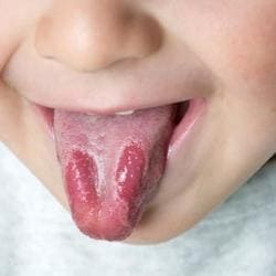 enfermedades de la lengua glositis