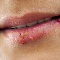 enfermedad bucal herpes oral