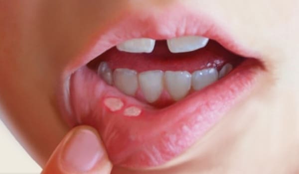 como curar las llagas en la boca