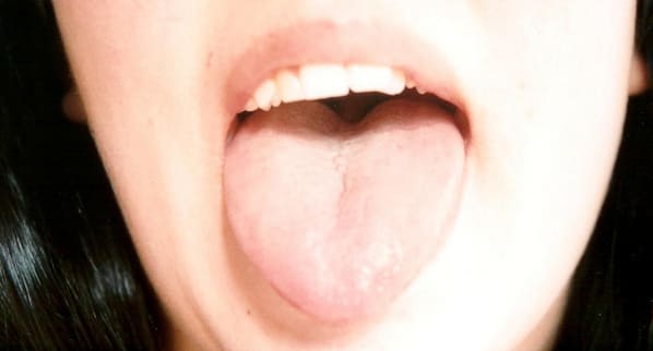 lengua hinchada tratamientos