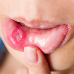 ulcera oral