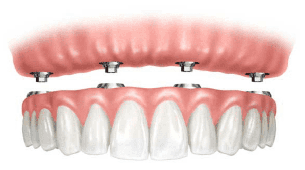 cuanto cuestan los implantes dentales