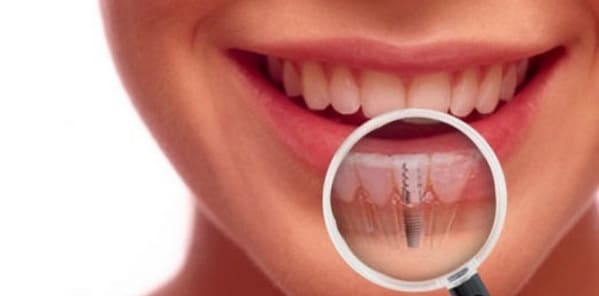 partes de implante dental