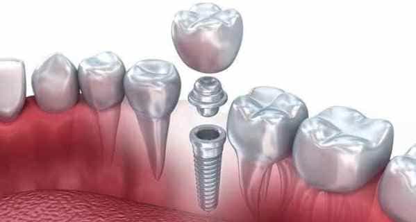 presupuestos implantes dentales