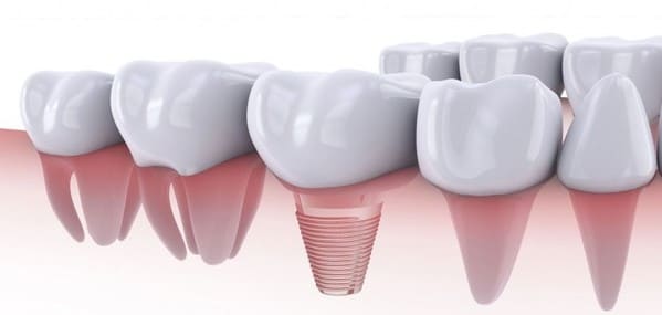 pruebas implantes dentales