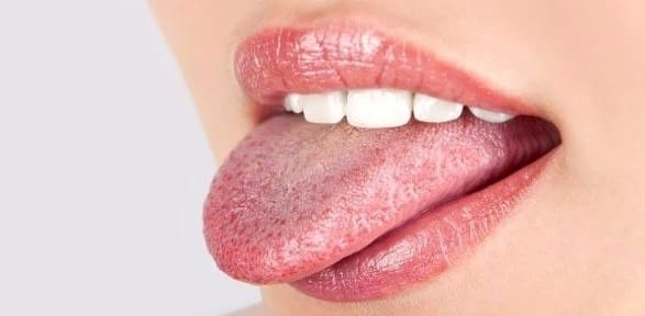 manchas rojas en la lengua