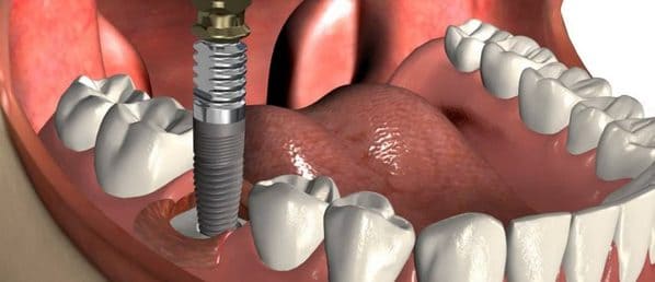 complicaciones implantes dentales