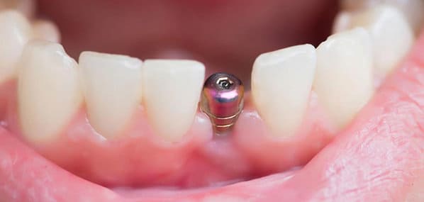 desventajas de los implantes dentales