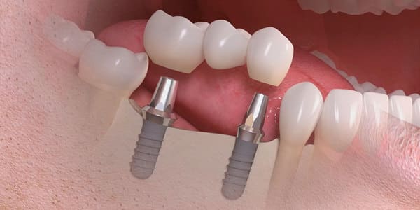 que se siente al llevar implantes dentales