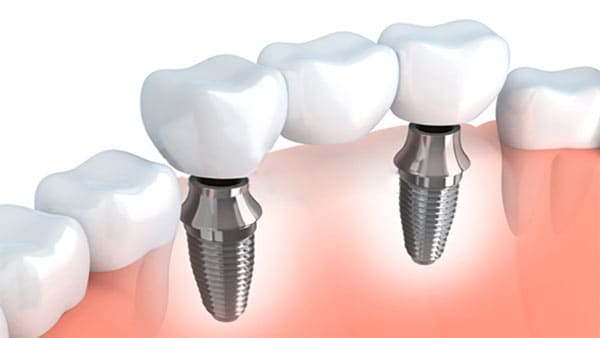 quitar implante dental