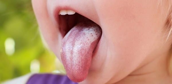 sintomas hongos en la lengua