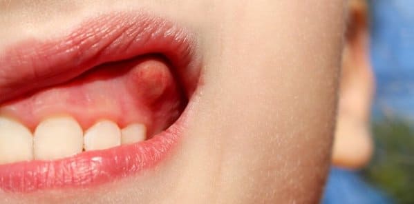 causas de absceso dental