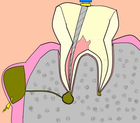 drenaje absceso dental
