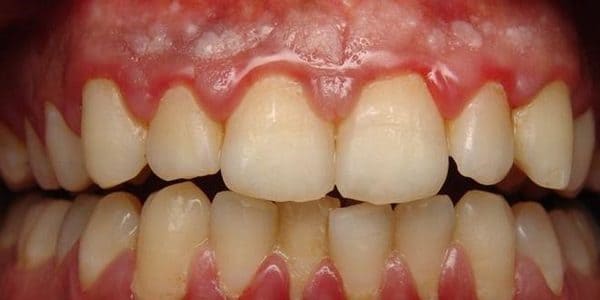 tipos de enfermedades periodontales