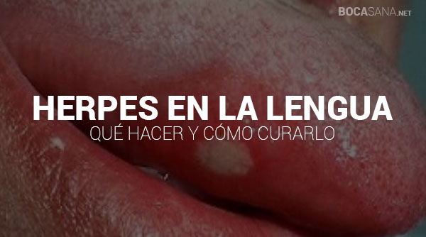 Herpes en la Lengua