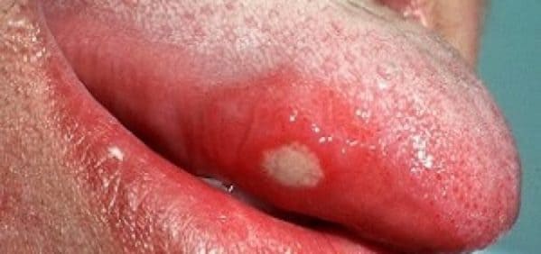 herpes en la lengua