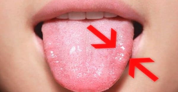 sintomas del herpes de la lengua