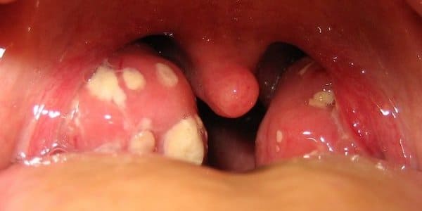 tonsilolitos o piedras en la garganta